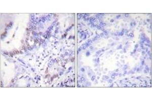 Immunohistochemistry analysis of paraffin-embedded human lung carcinoma, using Abl (Phospho-Tyr412) Antibody. (ABL1 Antikörper  (pTyr393))