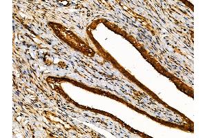 ABIN6259116 and ABIN6274466 at 1/100 staining Human ovarian cancer and adjacent normal tissues by IHC-P.