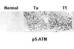 Anti-ATM Monoclonal Antibody - Immunohistochemistry Anti ATM monoclonal Antibody was used to show constitutive activation of the ATM pathway in human urinary bladder cancer.