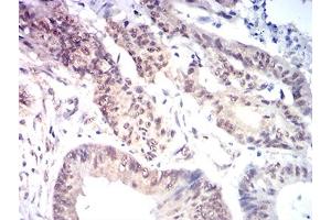 Immunohistochemical analysis of paraffin-embedded colon cancer tissues using KAT7 mouse mAb with DAB staining. (MYST2 Antikörper  (AA 1-200))