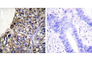 Peptide - +Immunohistochemical analysis of paraffin-embedded human lung carcinoma tissue using Claudin 7 antibody (#C0153). (Claudin 7 Antikörper)