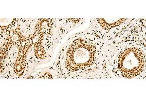 Immunohistochemistry of paraffin-embedded Human breast cancer tissue using ILF3 Polyclonal Antibody at dilution of 1:60(x200) (Interleukin enhancer-binding factor 3 (ILF3) Antikörper)
