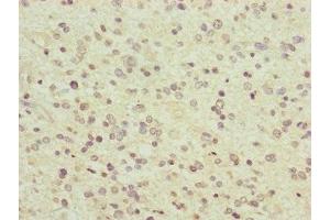 Immunohistochemistry of paraffin-embedded human glioma using ABIN7166519 at dilution of 1:100 (PCDHA12 Antikörper  (AA 862-941))
