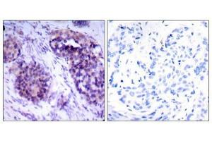 Immunohistochemical analysis of paraffin-embedded human breast carcinoma tissue using BCL-XL (phospho-Ser62) antibody.