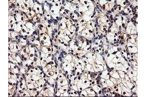 Immunohistochemical staining of paraffin-embedded Carcinoma of Human kidney tissue using anti-DPP9 mouse monoclonal antibody. (DPP9 Antikörper)