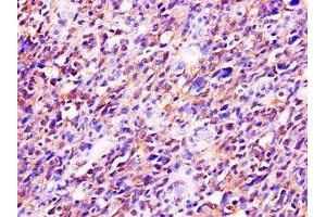 Immunohistochemistry of paraffin-embedded human glioma using ABIN7173542 at dilution of 1:100 (C22orf28 Antikörper  (AA 52-229))