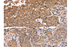 The image on the left is immunohistochemistry of paraffin-embedded Human lung cancer tissue using ABIN7128119(ABCB6 Antibody) at dilution 1/15, on the right is treated with fusion protein. (ABCB6 Antikörper)