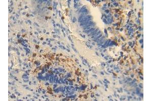 IHC-P analysis of Human Colorectal cancer Tissue, with DAB staining. (OTC Antikörper  (AA 78-129))