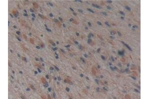 Detection of MAPT in Human Glioma Tissue using Polyclonal Antibody to Tau Protein (MAPT)