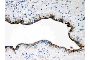 Anti-Occludin antibody, (ABIN3043585),IHC(P)IHC(P): Human Mammary Cancer Tissue (Occludin Antikörper  (AA 373-522))