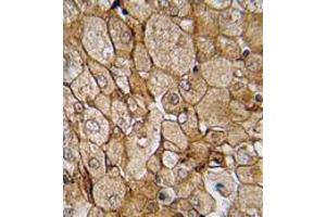 Formalin-fixed and paraffin-embedded human testis tissue (prostata carcinoma) reacted with CAMK1G (Center) , which was peroxidase-conjugated to the secondary antibody, followed by DAB staining. (CAMK1G Antikörper  (Center))