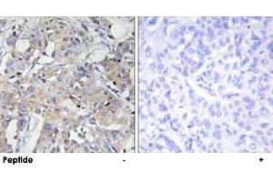 Immunohistochemistry analysis of paraffin-embedded human breast carcinoma tissue using COL6A3 polyclonal antibody . (COL6a3 Antikörper  (AA 2261-2310))
