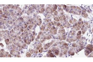 ABIN6273303 at 1/100 staining Human pancreas cancer tissue by IHC-P. (RAB12 Antikörper  (C-Term))