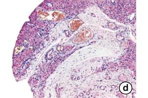 Immunhistochemistry image of OPN staining in paraffin sections of synovial tissue of pigmented villonodular synovitis (PVNS) patients. (Osteopontin Antikörper  (AA 164-179))