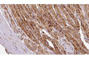 ABIN6267126 at 1/100 staining Human thyroid cancer tissue by IHC-P.