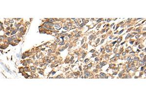 Immunohistochemistry of paraffin-embedded Human esophagus cancer tissue using RCAN3 Polyclonal Antibody at dilution of 1:60(x200) (RCAN3 Antikörper)