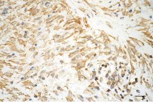 Immunohistochemistry was performed on paraffin-embedded human hepatocarcinoma using aggrecan antibody (ABIN7797541), 1:200). (Rekombinanter Aggrecan Antikörper)