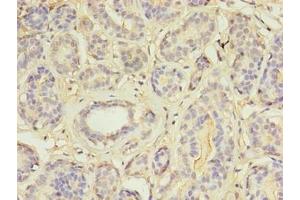 Immunohistochemistry of paraffin-embedded human breast cancer using ABIN7159004 at dilution of 1:100 (MAP3K7CL Antikörper  (AA 1-142))