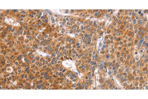 Immunohistochemistry of paraffin-embedded Human liver cancer tissue using ABO Polyclonal Antibody at dilution 1:50 (ABO Antikörper)