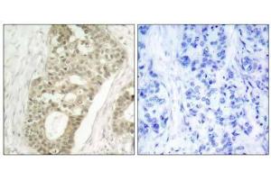 Immunohistochemical analysis of paraffin-embedded human breast carcinoma tissue using PKCδ (phospho- Ser645) antibody (E011296). (PKC delta Antikörper  (pSer645))