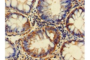 Immunohistochemistry of paraffin-embedded human colon cancer using ABIN7153928 at dilution of 1:100 (GPI Antikörper  (AA 2-554))