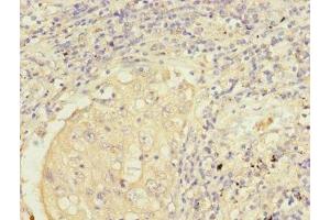Immunohistochemistry of paraffin-embedded human lung cancer using ABIN7149955 at dilution of 1:100 (FMO2 Antikörper  (AA 210-470))