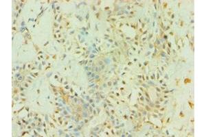 Immunohistochemistry of paraffin-embedded human breast cancer using ABIN7145226 at dilution of 1:100 (BAG5 Antikörper  (AA 198-447))