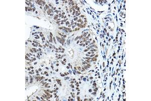 Immunohistochemistry of paraffin-embedded human colon carcinoma using P Rabbit pAb (ABIN3022375, ABIN3022376, ABIN3022377, ABIN1513310 and ABIN6218769) at dilution of 1:150 (40x lens). (Paired Box 3 Antikörper  (AA 1-206))