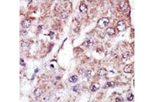 IHC analysis of FFPE human hepatocarcinoma stained with the MARK2 antibody (MARK2 Antikörper  (AA 600-630))