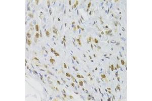 Immunohistochemistry of paraffin-embedded human gastric cancer using DOK1 Antibody (ABIN6130881, ABIN6139763, ABIN6139764 and ABIN6221343) at dilution of 1:100 (40x lens). (DOK1 Antikörper  (AA 1-280))