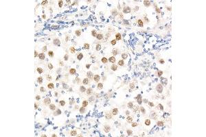 Immunohistochemistry of paraffin-embedded Human testicular seminoma using Nanog Rabbit pAb (ABIN1680964, ABIN3017620, ABIN3017621 and ABIN6220166) at dilution of 1:25 (40x lens). (Nanog Antikörper  (AA 1-100))