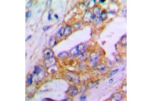 Immunohistochemical analysis of Aggrecan staining in human lung cancer formalin fixed paraffin embedded tissue section.