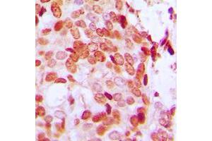 Immunohistochemical analysis of DAXX (pS668) staining in human breast cancer formalin fixed paraffin embedded tissue section. (DAXX Antikörper  (C-Term, pSer668))