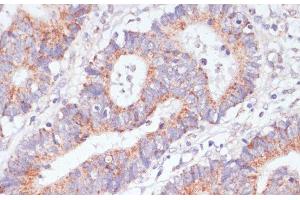 Immunohistochemistry of paraffin-embedded Human colon carcinoma using RAP1A Polyclonal Antibody at dilution of 1:100 (40x lens).