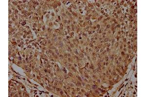 IHC image of ABIN7155407 diluted at 1:300 and staining in paraffin-embedded human cervical cancer performed on a Leica BondTM system.