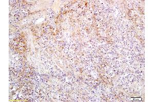 Formalin-fixed and paraffin embedded human colorectal cancer labeled with Anti SLC27A2 Polyclonal Antibody, Unconjugated (ABIN751393) followed by conjugation to the secondary antibody and DAB staining (SLC27A2 Antikörper  (AA 401-500))