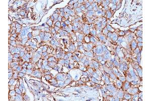 Formalin-fixed, paraffin-embedded human Breast Carcinoma stained with CD44 Mouse Monoclonal Antibody (156-3C11). (CD44 Antikörper)