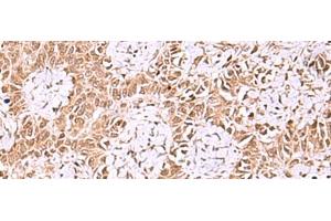 Immunohistochemistry of paraffin-embedded Human ovarian cancer tissue using IRX1 Polyclonal Antibody at dilution of 1:35(x200) (IRX1 Antikörper)