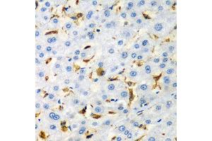 Immunohistochemistry of paraffin-embedded human liver injury using CD68 antibody at dilution of 1:200 (40x lens).