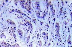 Immunohistochemistry (IHC) analyzes of ASK1 antibody in paraffin-embedded human breast carcinoma tissue. (ASK1 Antikörper)