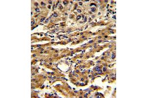 Formalin-fixed and paraffin-embedded human hepatocarcinoma reacted with ABCG1 Antibody (Center), which was peroxidase-conjugated to the secondary antibody, followed by DAB staining.