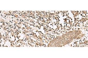 Immunohistochemistry of paraffin-embedded Human esophagus cancer tissue using FGF13 Polyclonal Antibody at dilution of 1:45(x200) (FGF13 Antikörper)
