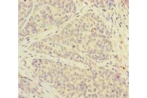Immunohistochemistry of paraffin-embedded human ovarian cancer using ABIN7152525 at dilution of 1:100 (FOXRED1 Antikörper  (AA 307-486))