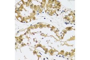 Immunohistochemistry of paraffin-embedded human breast using RPS12 antibody (ABIN5973491) at dilution of 1/100 (40x lens). (RPS12 Antikörper)