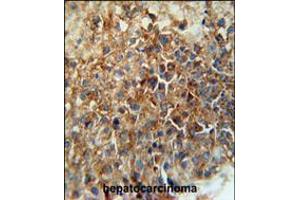 CD46 Antibody immunohistochemistry analysis in formalin fixed and paraffin embedded human hepatocarcinoma followed by peroxidase conjugation of the secondary antibody and DAB staining. (CD46 Antikörper  (C-Term))