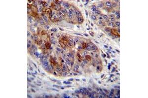 Imunohistochemistry analysis in formalin fixed and paraffin embedded human esophageal carcinoma reacted with HAX1 Antibody (C-term) followed by peroxidase conjugation of the secondary antibody and DAB staining. (HAX1 Antikörper  (C-Term))