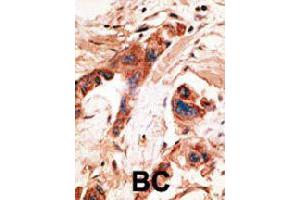 Formalin-fixed and paraffin-embedded human cancer tissue reacted with BMP2K polyclonal antibody  , which was peroxidase-conjugated to the secondary antibody, followed by AEC staining. (BMP2K Antikörper  (Internal Region))