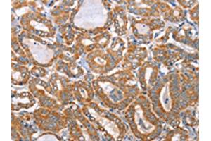 The image on the left is immunohistochemistry of paraffin-embedded Human thyroid cancer tissue using ABIN7130296(MTMR7 Antibody) at dilution 1/40, on the right is treated with fusion protein. (MTMR7 Antikörper)