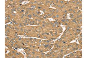 The image on the left is immunohistochemistry of paraffin-embedded Human liver cancer tissue using ABIN7192541(SLIT1 Antibody) at dilution 1/35, on the right is treated with synthetic peptide. (SLIT1 Antikörper)
