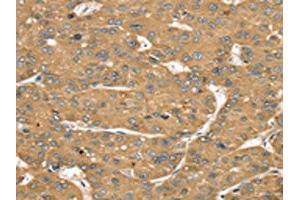The image on the left is immunohistochemistry of paraffin-embedded Human liver cancer tissue using ABIN7192541(SLIT1 Antibody) at dilution 1/35, on the right is treated with synthetic peptide.